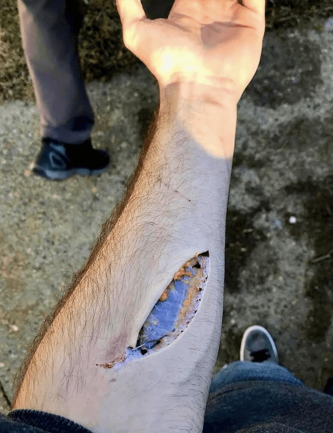 罕见的人体筋膜照，就是伤口下的那层“白色薄膜”

筋膜分成浅筋膜和深筋膜，浅筋膜