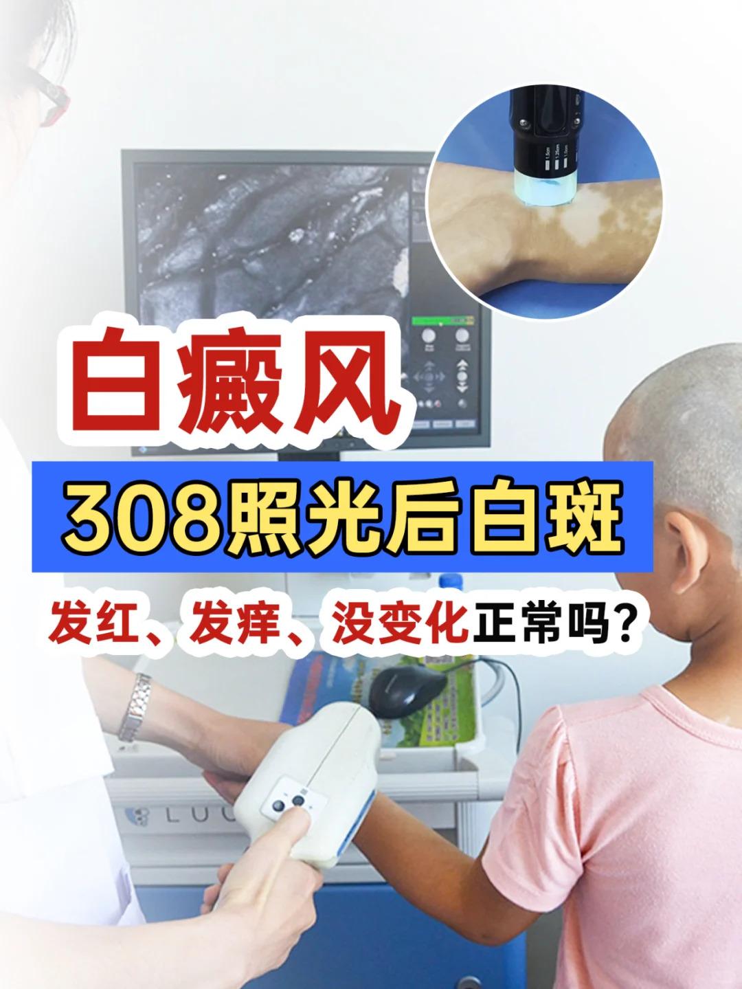白癜风308照光后出现白斑发红、发痒、没变化等情况，是否正常需要具体分...