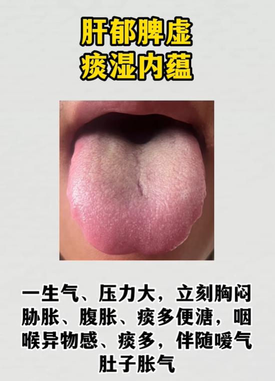齿痕舌、厚腻苔暗藏问题，3 类典型舌诊，分清肝郁脾虚与下焦湿热