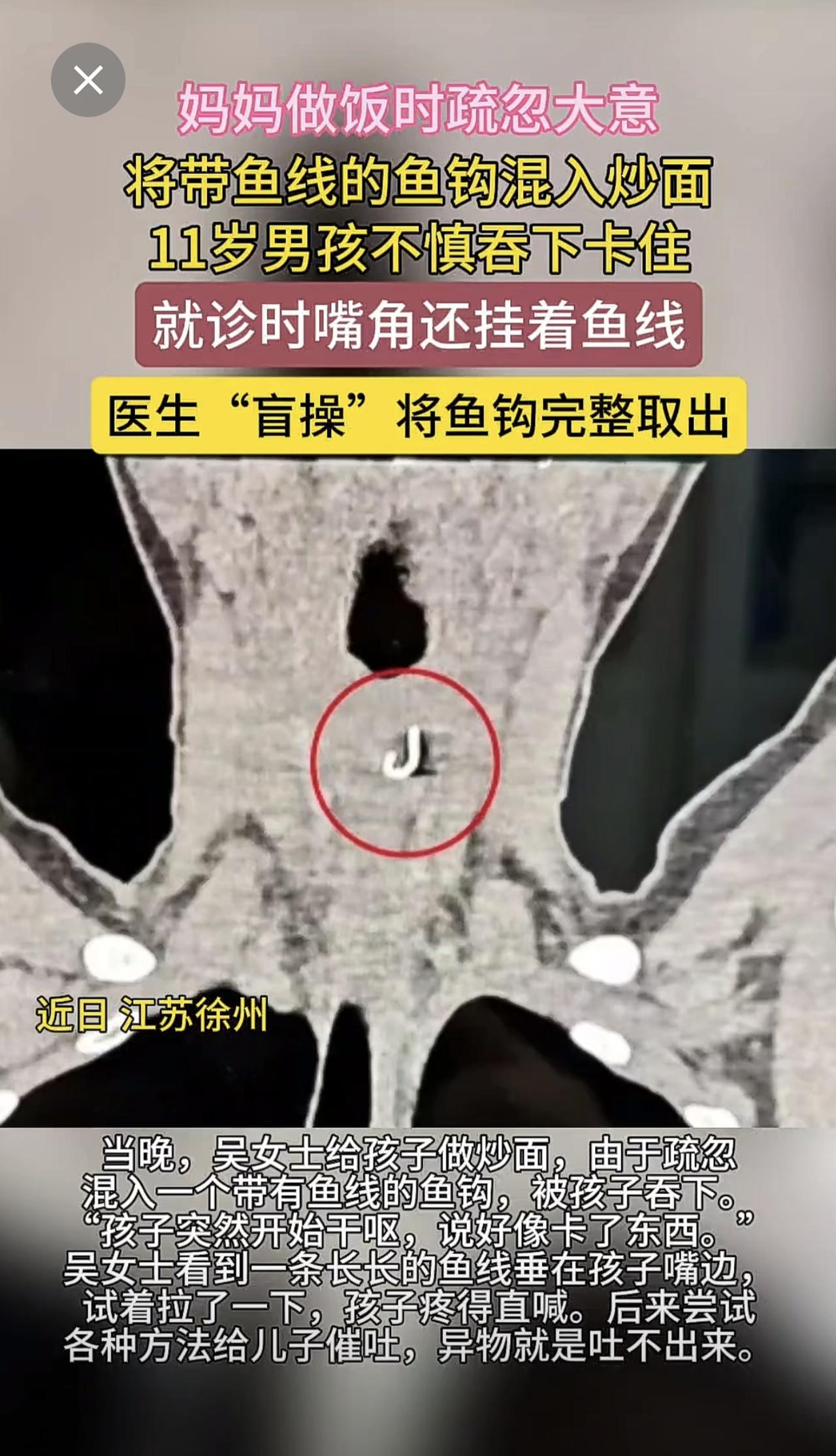 妈妈疏忽将带鱼线的鱼钩混入炒面
11岁男孩不慎吞下卡住（现代快报）