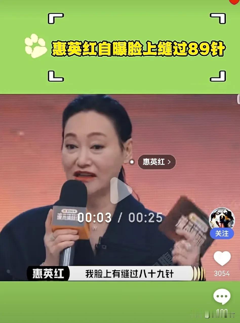 最近炸出一位“缝纫机女王”——惠英红老师！

她在节目里自曝脸上缝过89针，网友