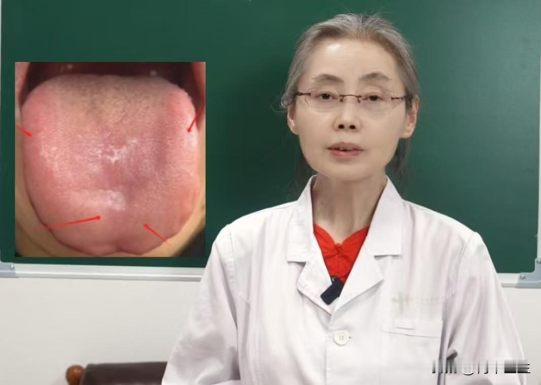 这种舌象，舌苔干净，也不能上来就补!

前两天一位38岁的李先生来找我看诊，他的