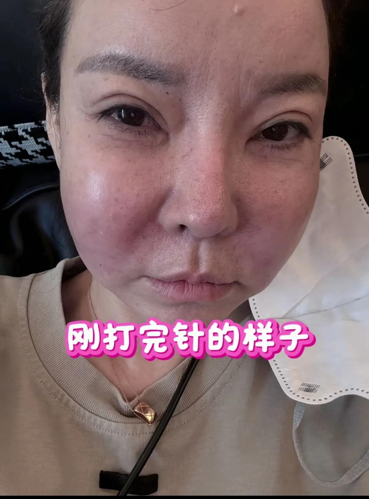 整容脸，肿的像发面馒头，毫无美感可言。

期待消肿后变美丽。