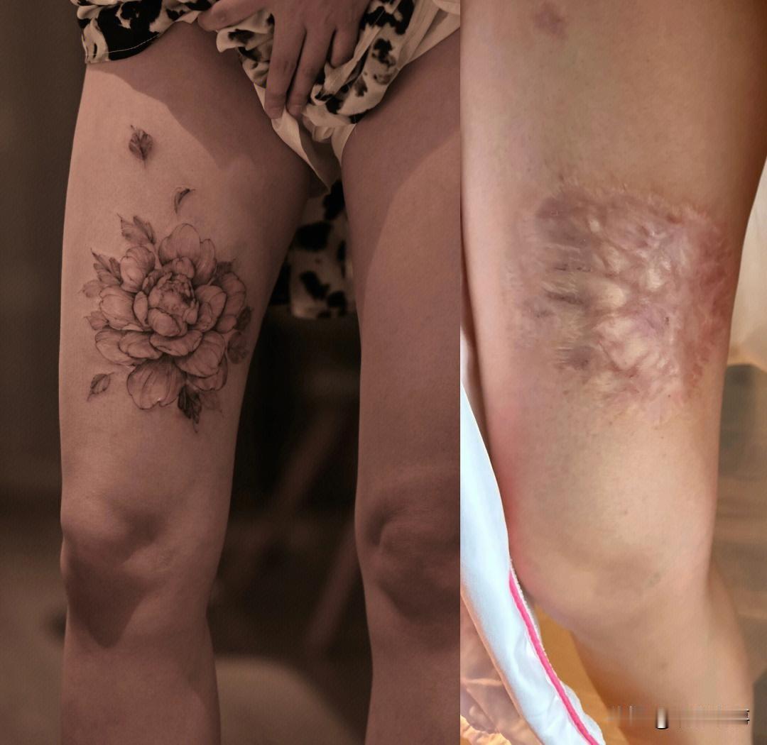 在福建省福州市，一位普拉提教练因为长达二十多年的腿部烫伤疤痕而一直避免露出双腿。