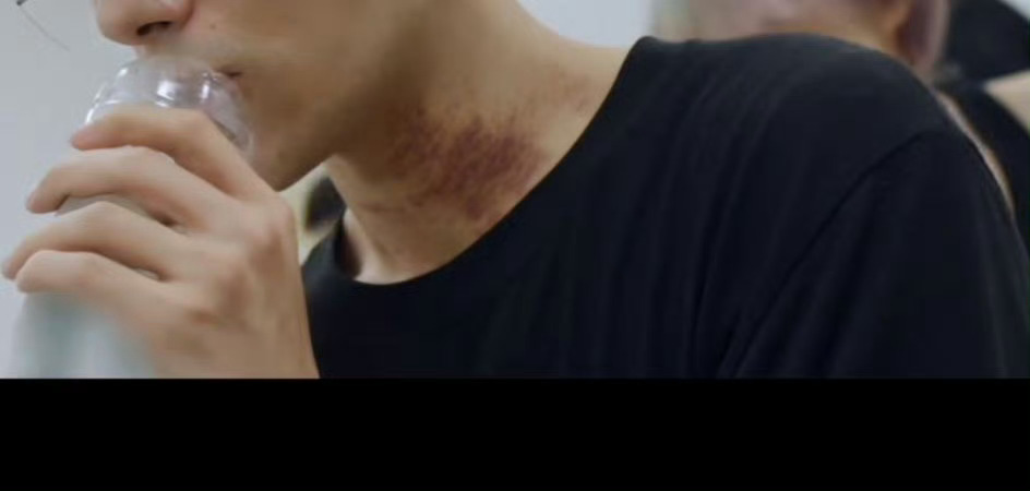 易烊千玺好明显的刮痧痕迹易烊千玺好明显的男人的勋章 男人的勋章！易烊千玺你对自己
