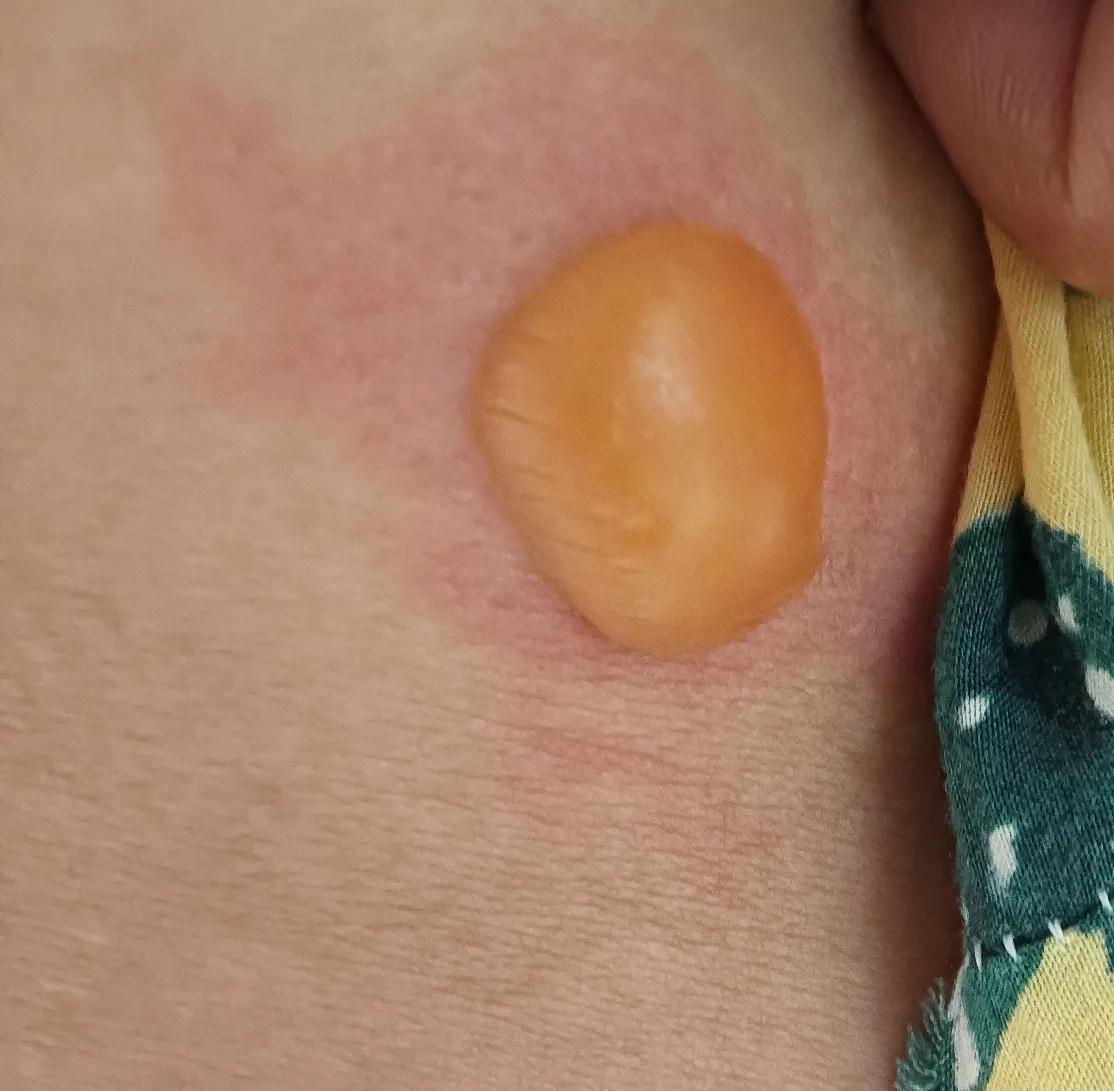 上午我用盐袋热敷腰部，晚上要睡觉时，竟然发现我的腰部被盐袋烫出来个直径两三厘米的