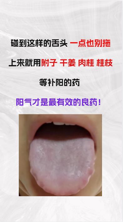出现这样的舌头，一点也别拖，赶紧用干姜桂枝等大辛大热的补阳药！！阳气才是最最有效