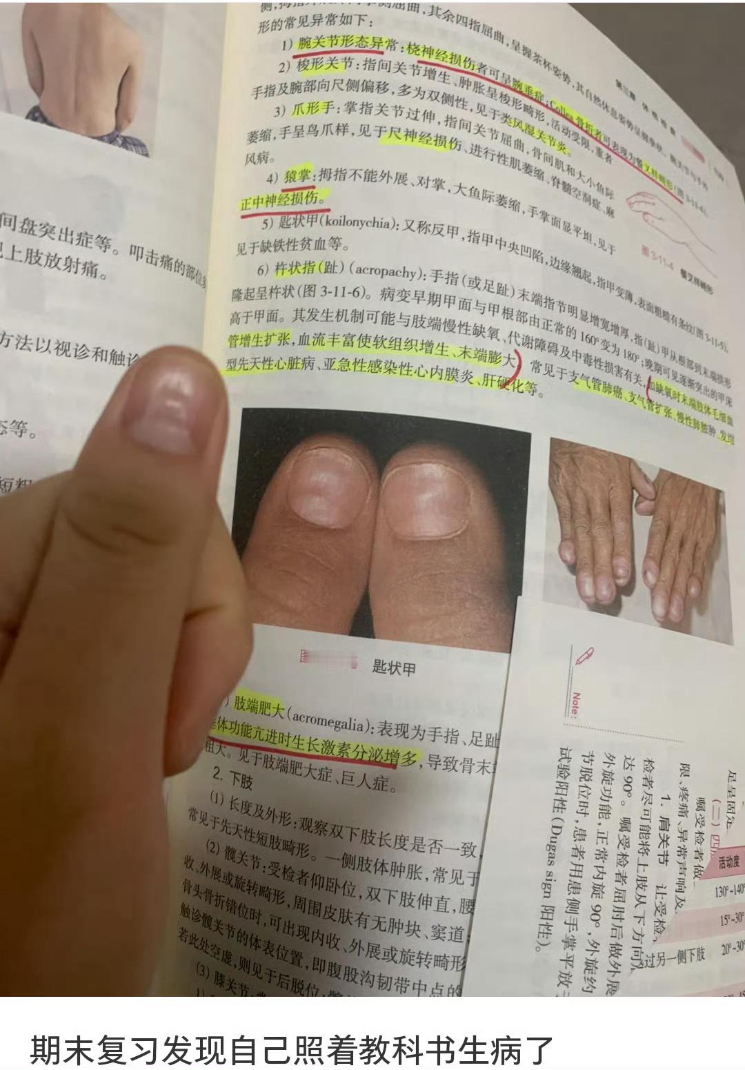 我右手大拇指好像也是这样的 