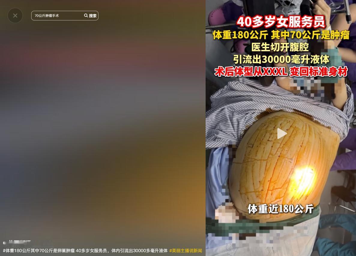 5月11日美丽浙江报道，浙江40岁女子周某体重180斤，肚子硬得像石头，试遍减肥