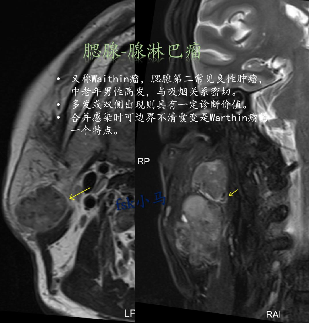 腺淋巴瘤(Warthin瘤)：腮腺第二常见的良性肿瘤，多见于老年男性...