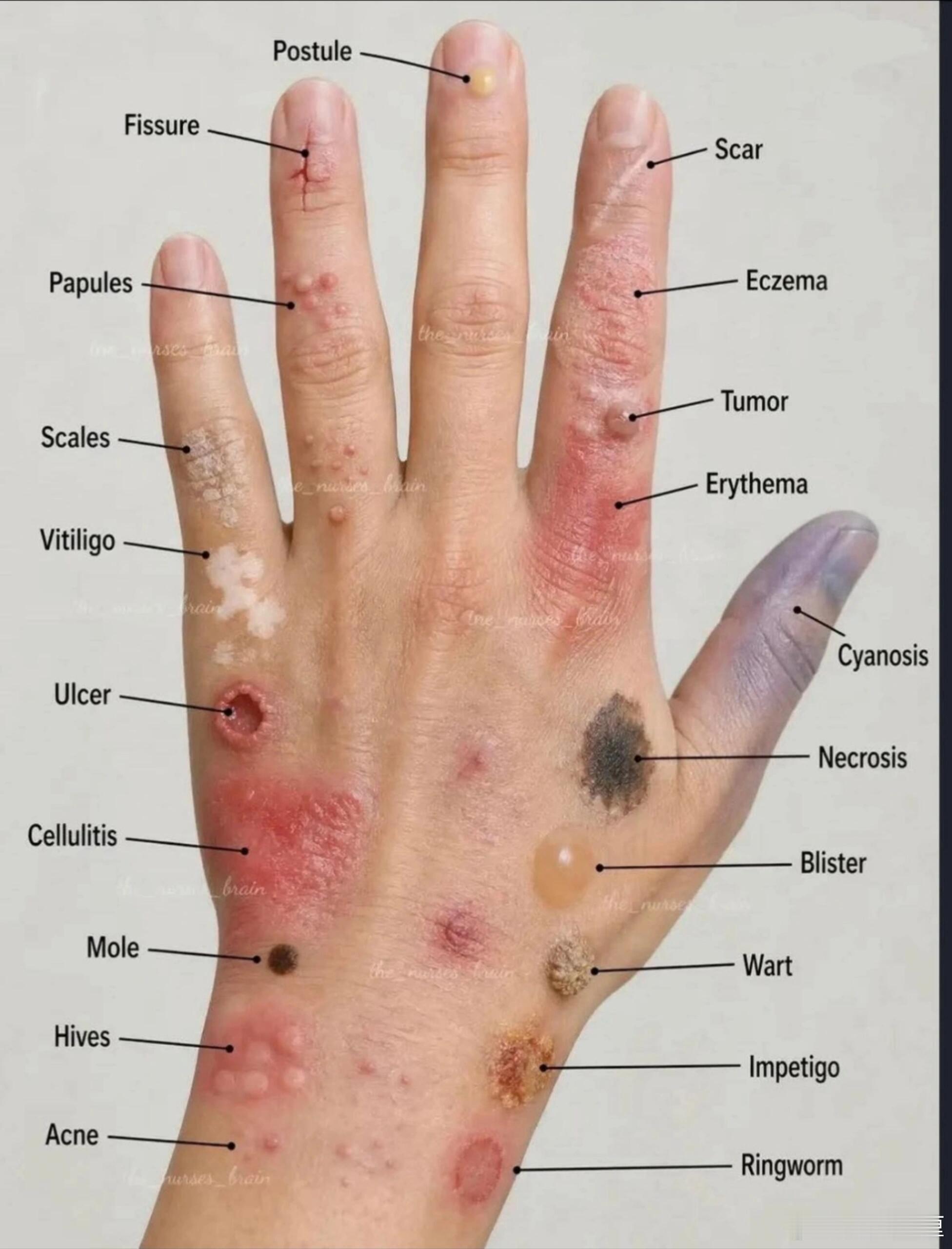 以为没事但很严重的皮肤病肉眼看着轻微的小皮损，皮下炎症、过敏反应或许早已加重，皮