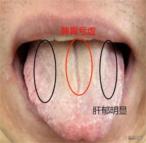 这样的舌头，舌面中间一条长长的裂纹，如果你以为是脾虚，参苓白术散、归脾丸吃个半年