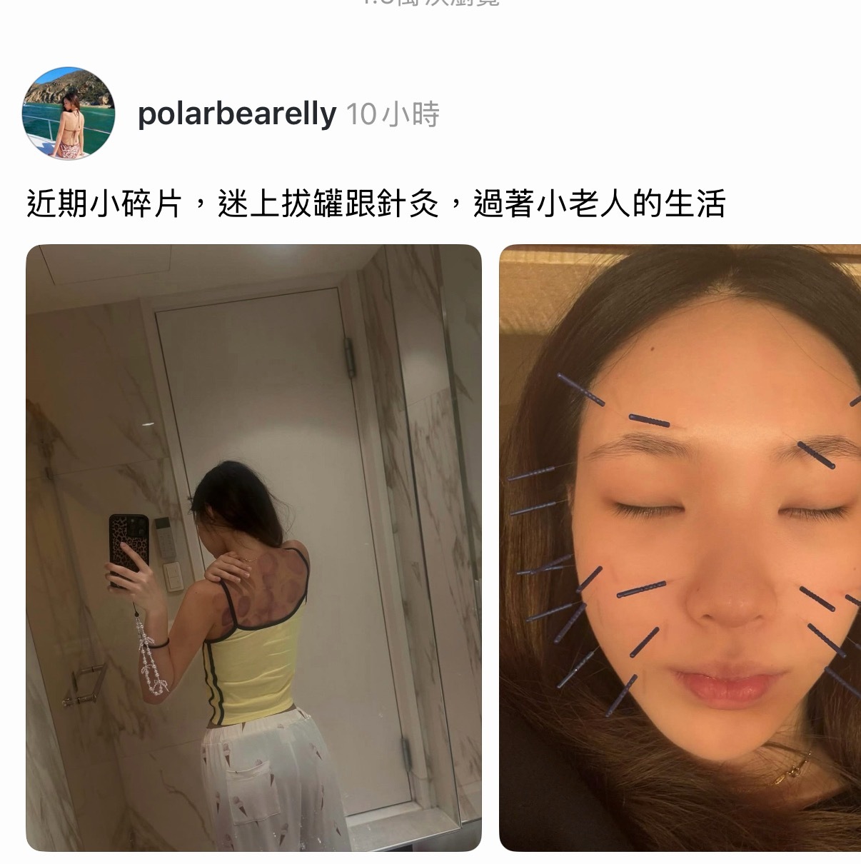 Elly 许曦文针灸拔罐小老人生活的日常📝 