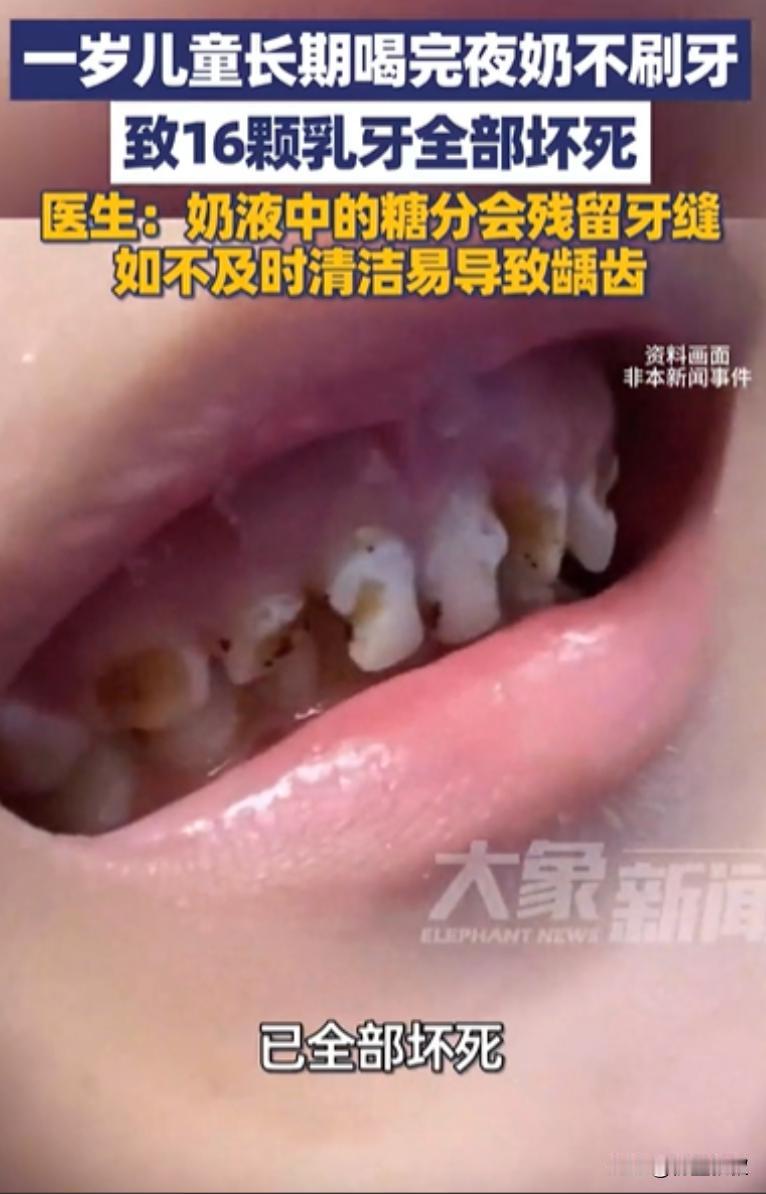 担心的事还是发生了！杭州，1岁儿童喝完夜奶不刷牙，结果16颗乳牙全部坏死，就连牙