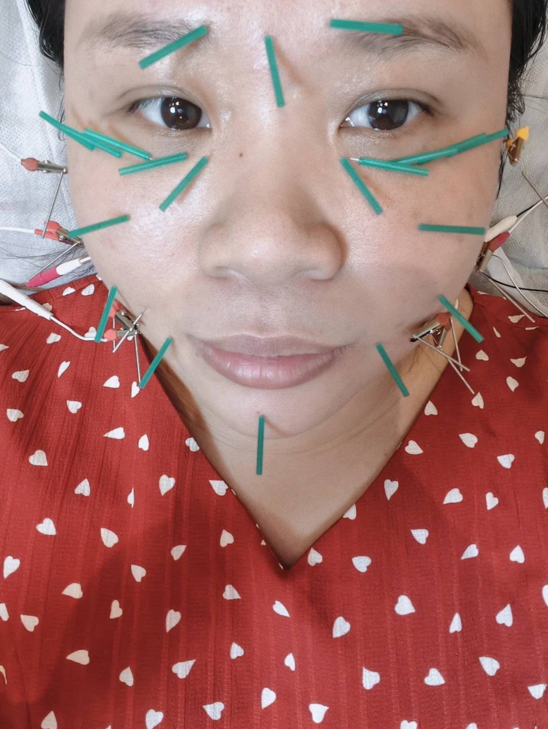 谁说针灸不能抗衰？