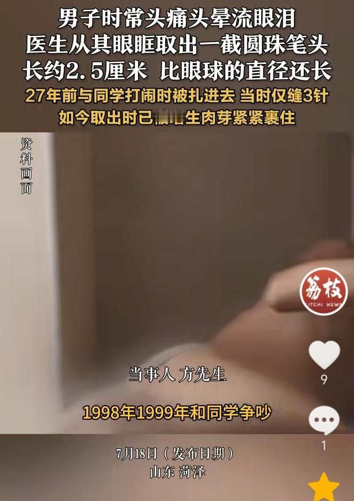 “是个狠人”！山东菏泽，男子时常头疼头晕流眼泪，到医院检查后发现眼睛里有异物，结