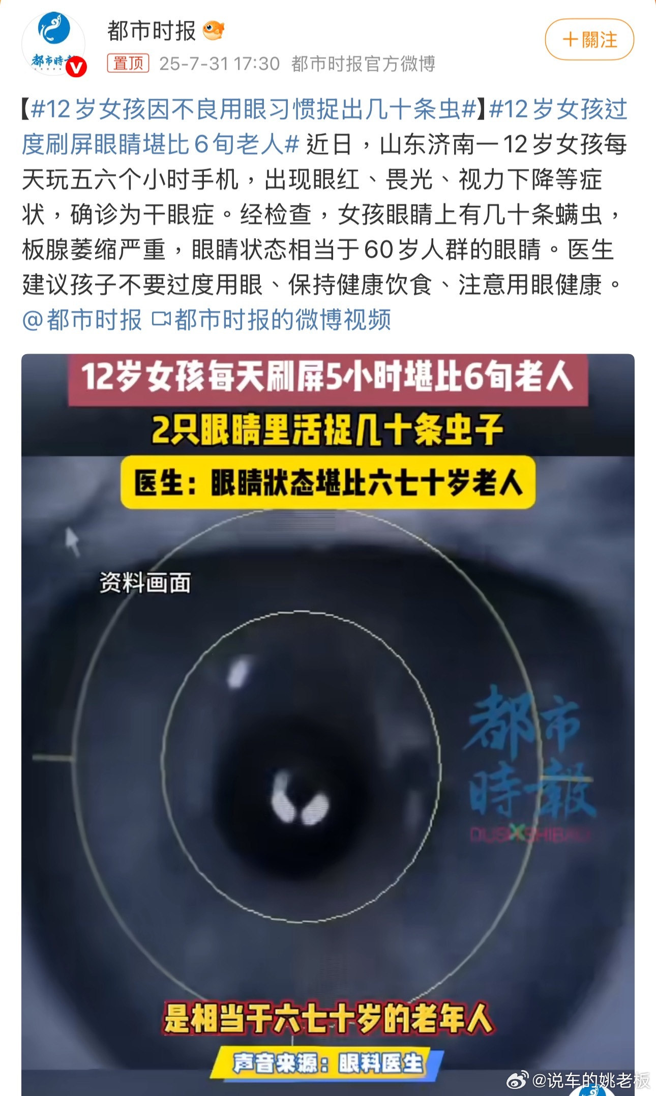 眼睛里藏着虫子？光是想想就起鸡皮疙瘩！家里有娃的可得上心了：勤给娃洗手，宠物定期