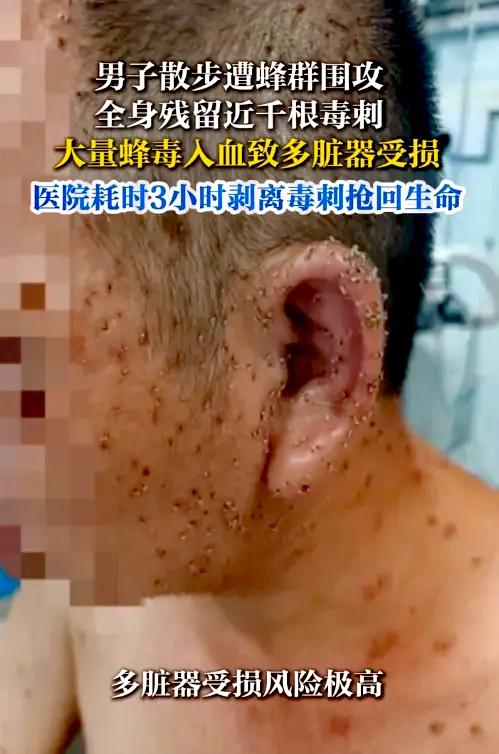 9月16日报道，湖北嘉鱼，一男子散步时，突然被蜂群围攻，他被扎得惨叫连连，送进医