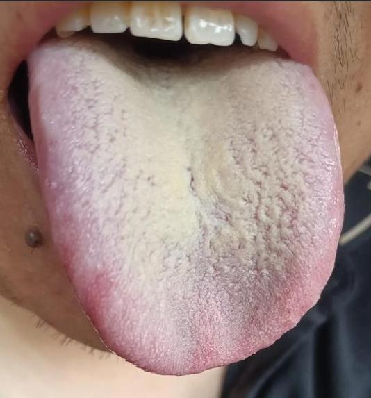 这类的舌象患者的话，治疗起来，就比较麻烦[黑线]
舌头以白色为主，舌面却有一层黄