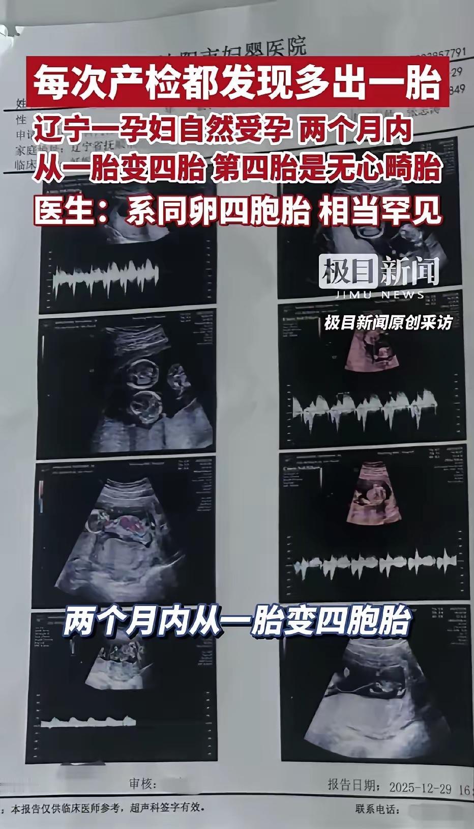辽宁抚顺，一位30岁女子自然受孕后去医院产检，结果却发现，每一次产检胎儿都会多一