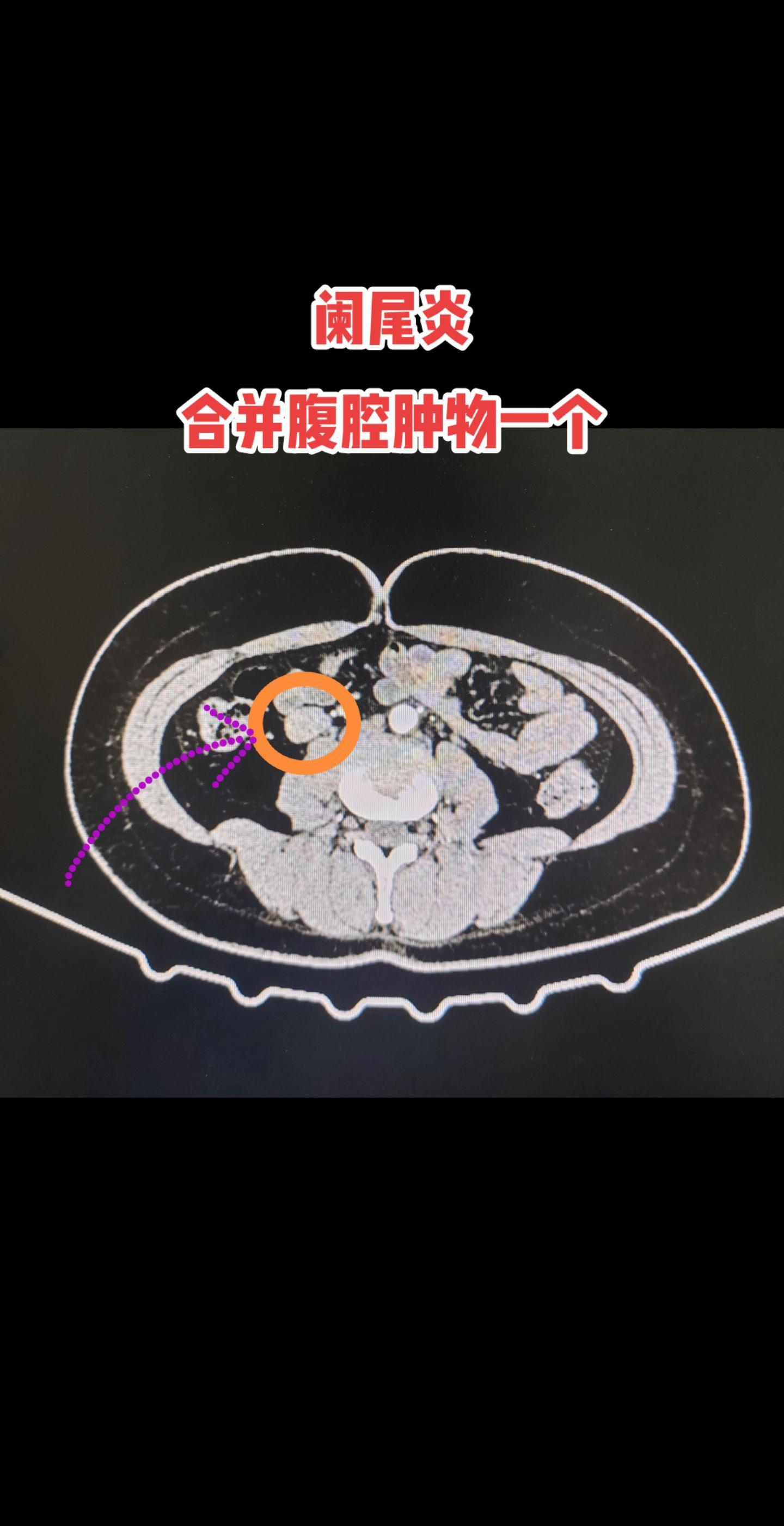 微创手术切除阑尾及腹腔肿物。