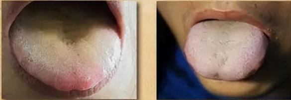 痰湿生于脾，源于肝，储于肺，根于肾；教你一招，搞定痰多湿气重[谢谢][谢谢][谢