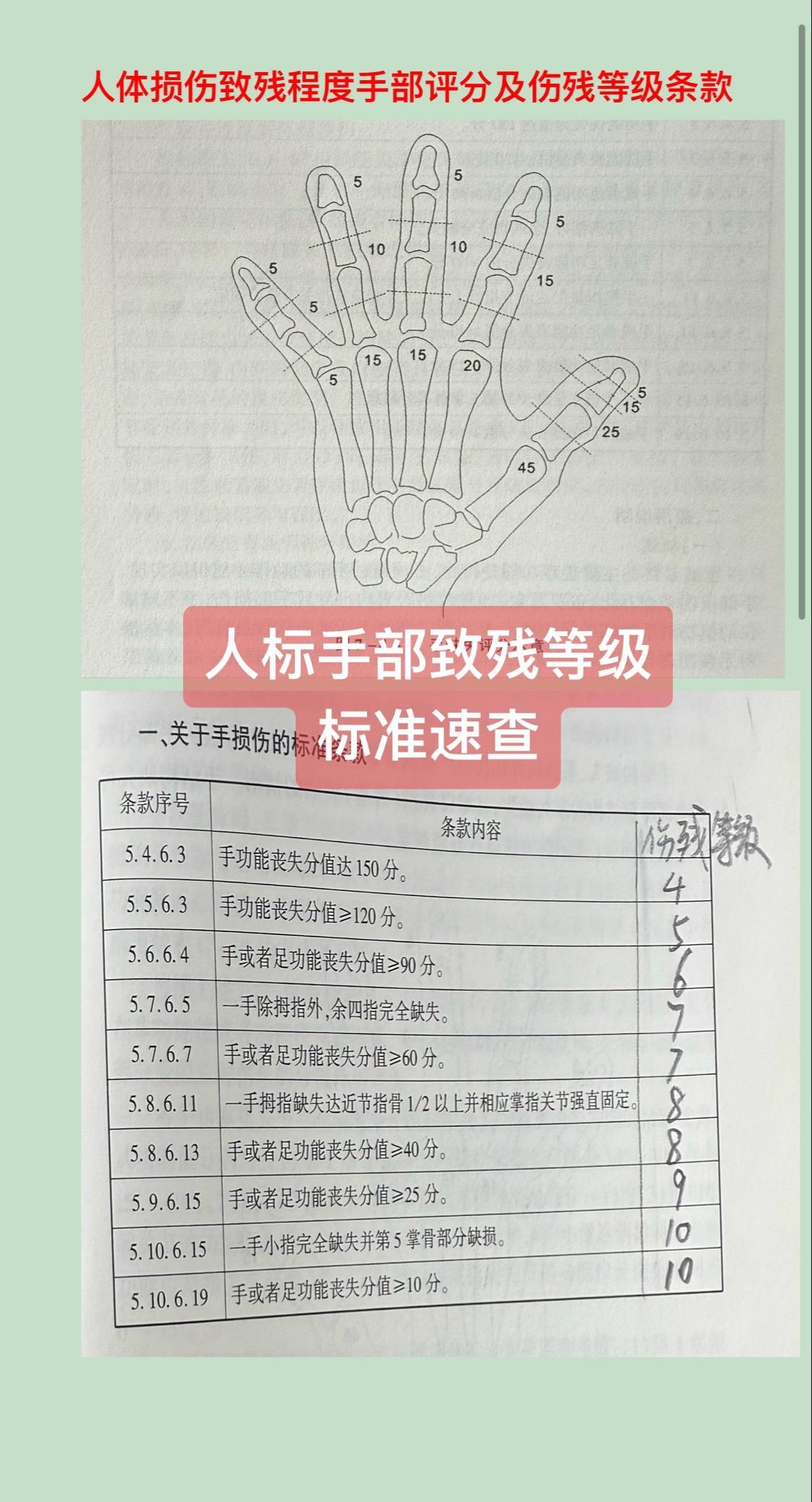 《人体损伤致残程度分级》俗称人标，整理出手部缺失评分示意图及对应标准条款，便于速