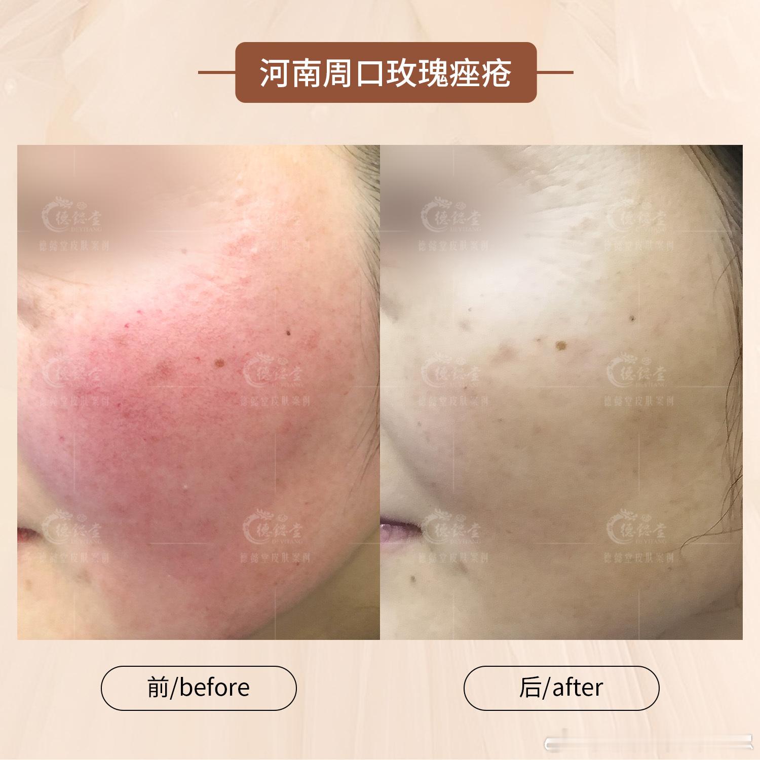 【医案】 玫瑰痤疮[超话]  贺女士玫瑰痤疮多年，脸颊总是红红的，一直没有好的解