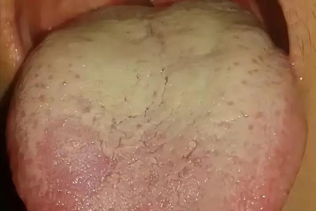 湿热不除，补也是毒！3个中成药，疏肝健脾清湿热！！！

老话常说“湿热不除，补也