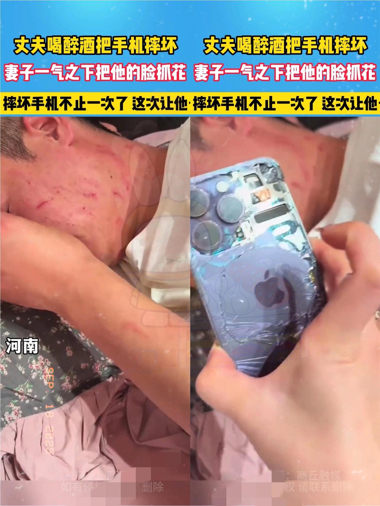 谁能想到啊，就因为老公出去喝大了把手机摔了，回家直接被老婆抓花了脸！老婆还气呼呼