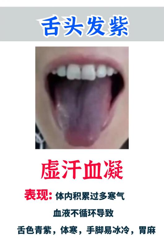 舌头发紫、有红点、有裂纹？6 种舌象信号别忽视