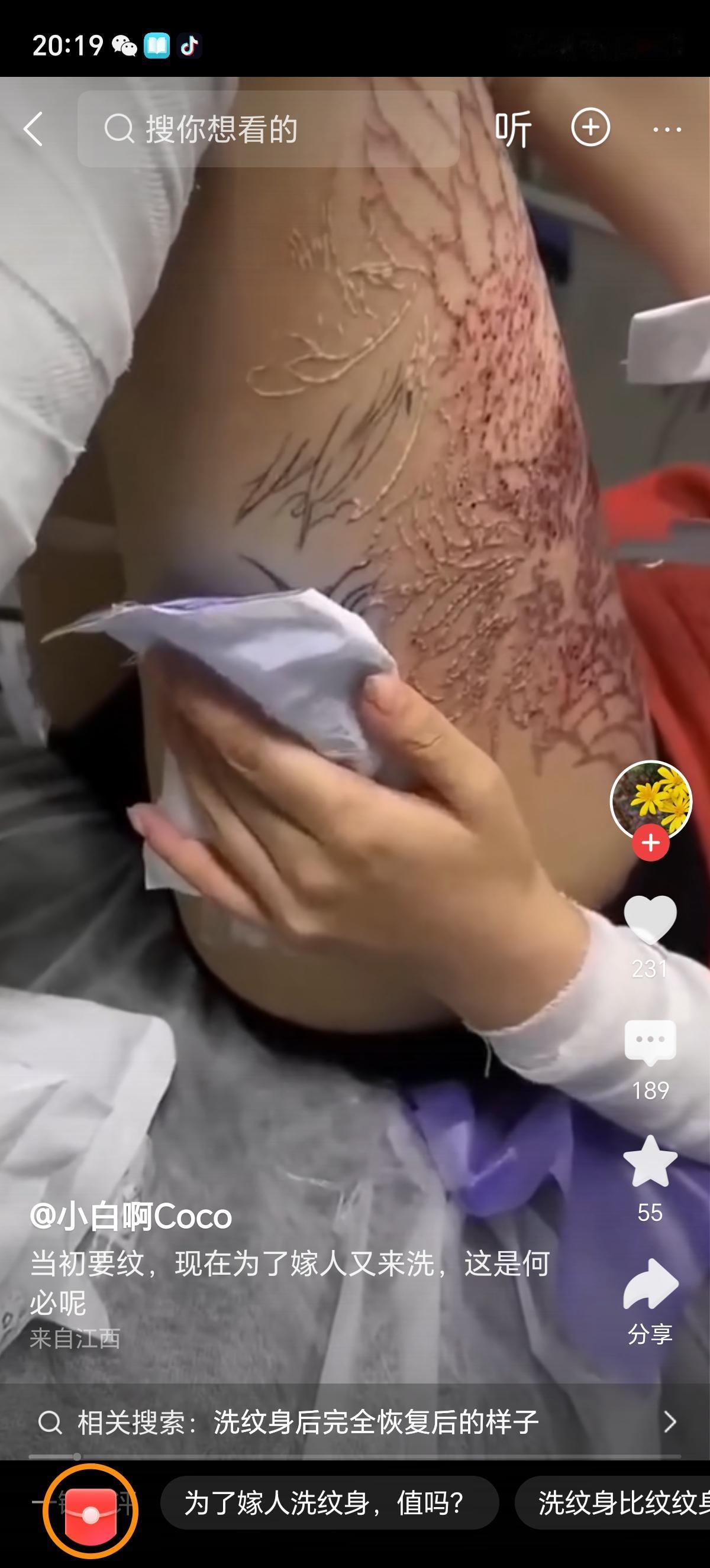 这女孩用的是激光纹身，这种激光清洗纹身的手法，皮肤会出现轻微损伤，会结痂。
这个