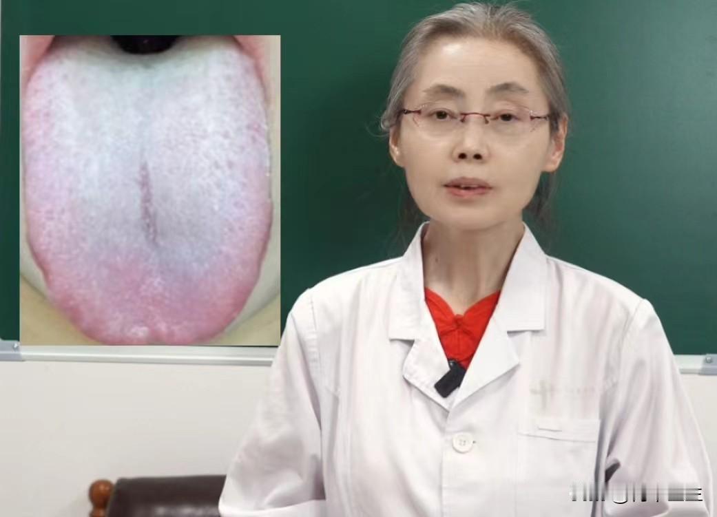 舌头这么白，别再健脾祛湿了，温肾阳才是重中之重

患者主诉：精神萎靡，爱犯困发呆