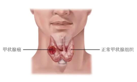 美国ATA分化型甲状腺癌指南之复发高危因素