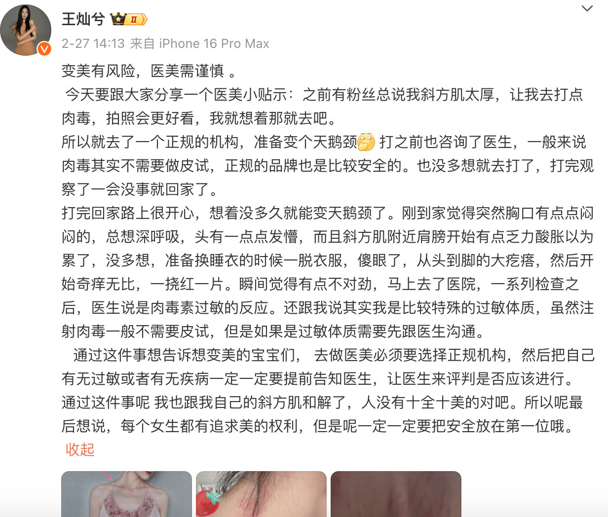 王灿打肉毒全身过敏  杜淳妻子打肉毒全身过敏  27日，杜淳妻子王灿自曝打肉毒全