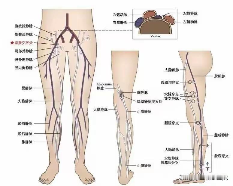 CHIVA手术的最佳时机对应几级静脉曲张？
指南观点：CHIVA优先推荐CEAP