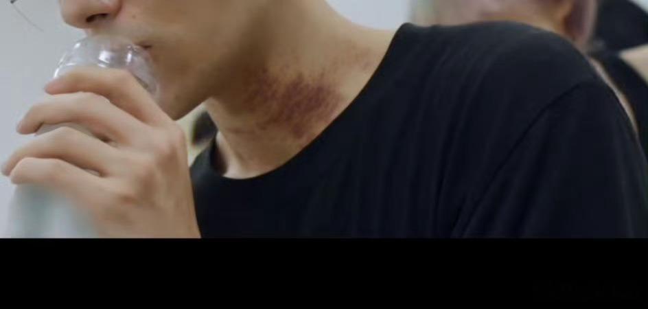 易烊千玺好明显的刮痧痕迹易烊千玺好明显的男人的勋章 男人的勋章！易烊千玺你对自己