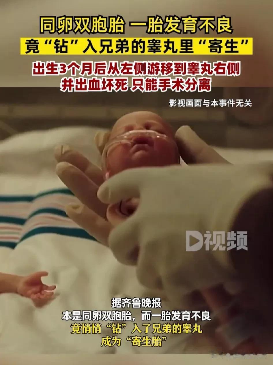 世所罕见！“胎中胎”婴儿成功进行分离手术，10月25日康复出院。

今年6月份，