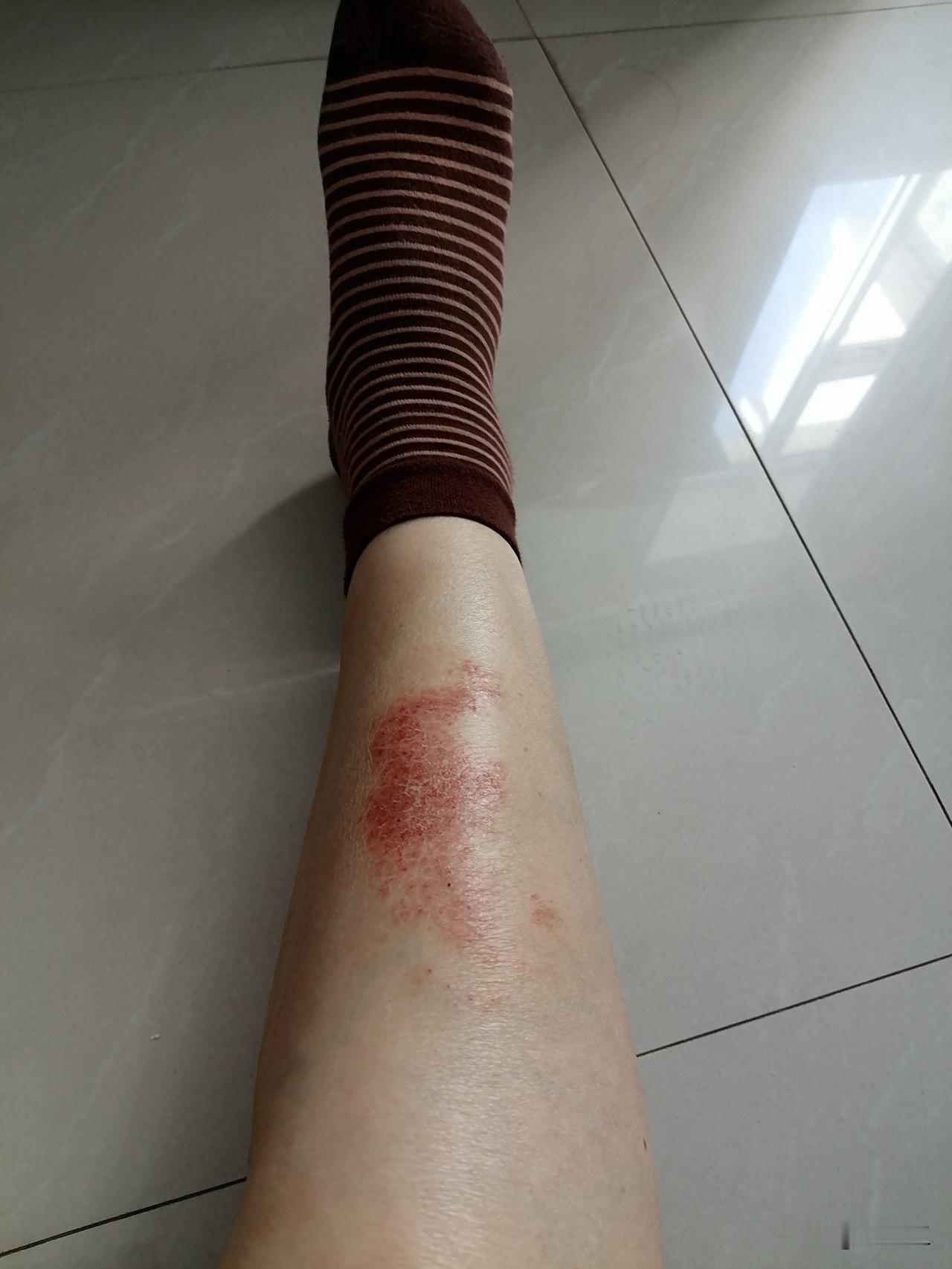 腿还是痒，但是我打定主意，这次啥药也不用了，就干挺着，我看看能不能养好。

这些