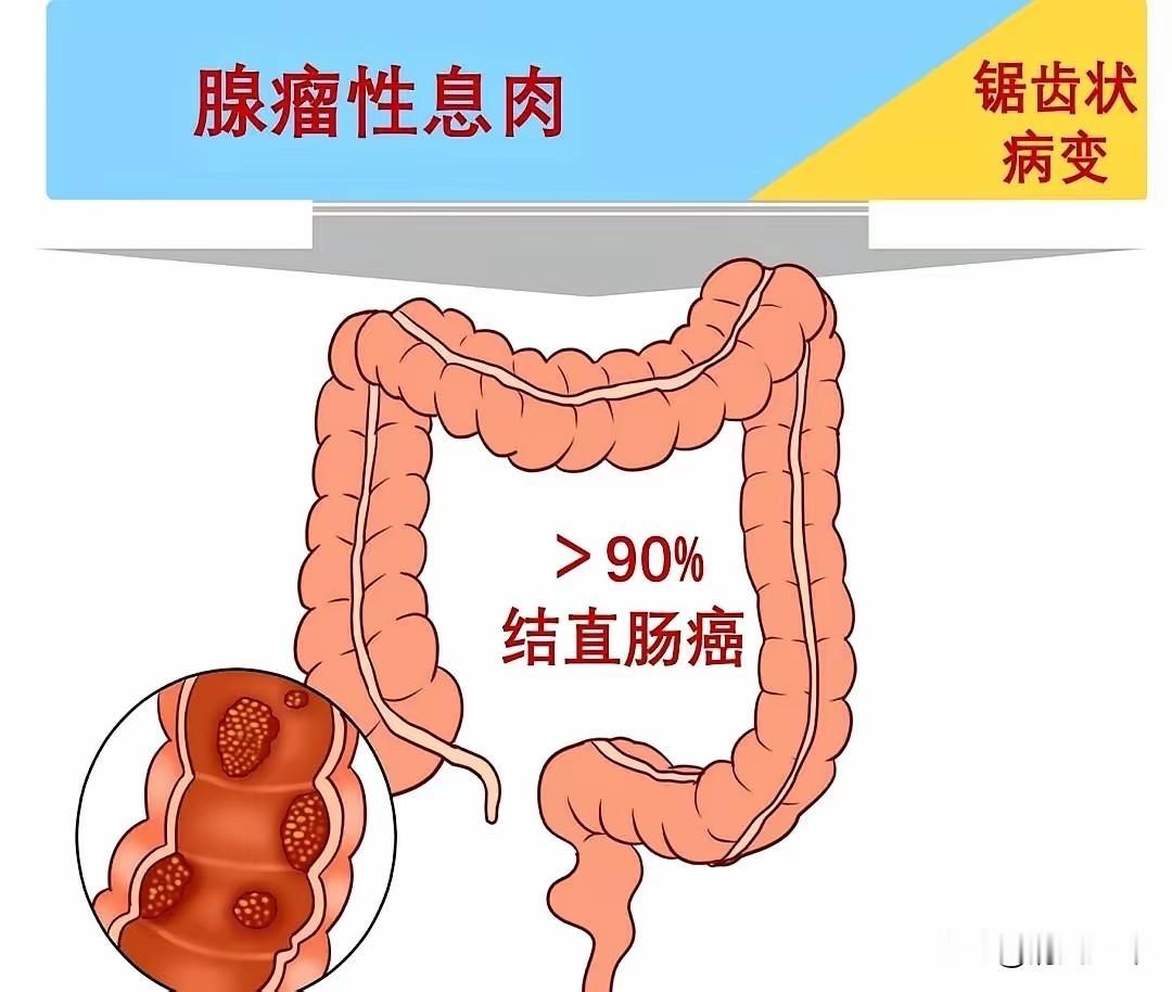 59岁的李先生，人往检查床上一躺，还跟医生开玩笑：“我啥感觉没有，就是来走个流程