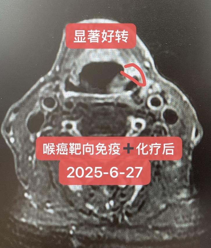 高龄局部晚期喉癌的治疗。78岁男性，确诊局部晚期声门上型喉癌（cT4a...