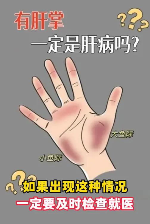 有肝掌就一定是肝病吗？ 如果出现这种情况，一定要及时检查就医！    ...