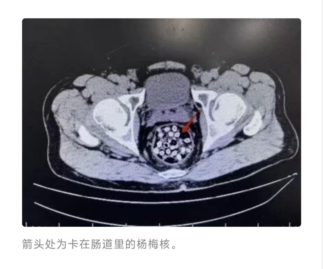 谁能想到，半筐杨梅下肚，差点把人送进鬼门关！
肛门剧痛、冷汗直冒，肚子里的CT影