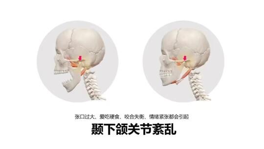 中医如何认识→颞下颌关节紊乱病（TMD）