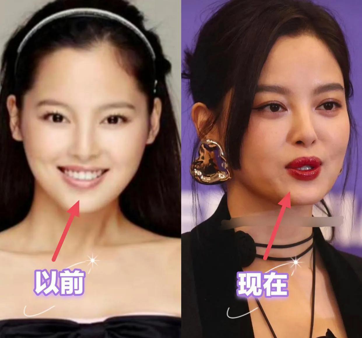 辛芷蕾的厚嘴唇是整的?跟早期照片对比明显变化还是挺大的，明明以前也是很清纯漂亮的