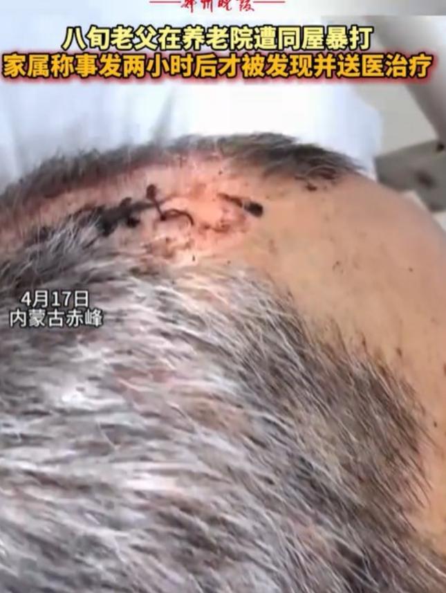 内蒙古，女子将丈夫送到养老院，几天后接丈夫，只见丈夫裤子直接裂开到裤裆，上衣后背