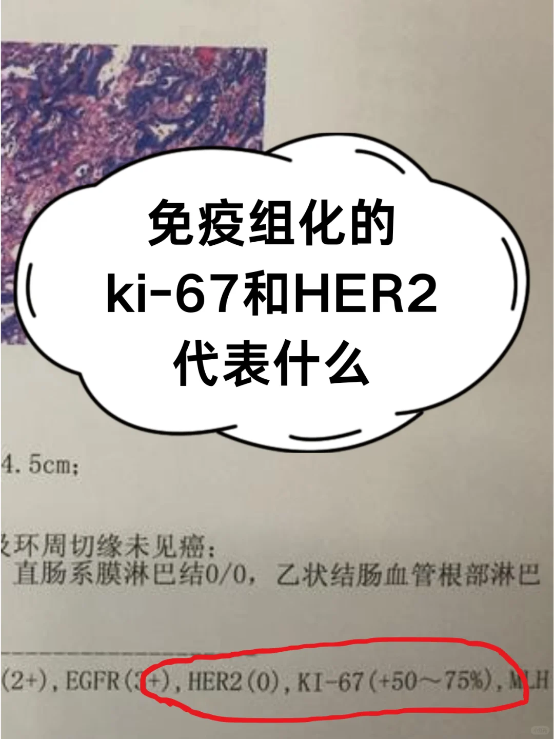 免疫组化中的ki-67和HER2代表什么？