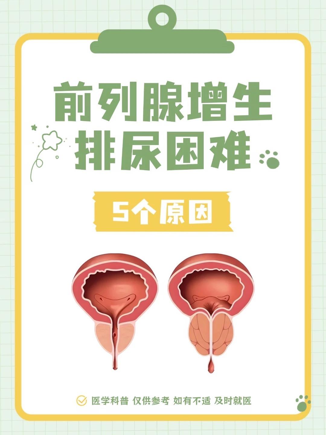 前列腺增生伴随排尿困难，男性可以自查这 5 个诱因