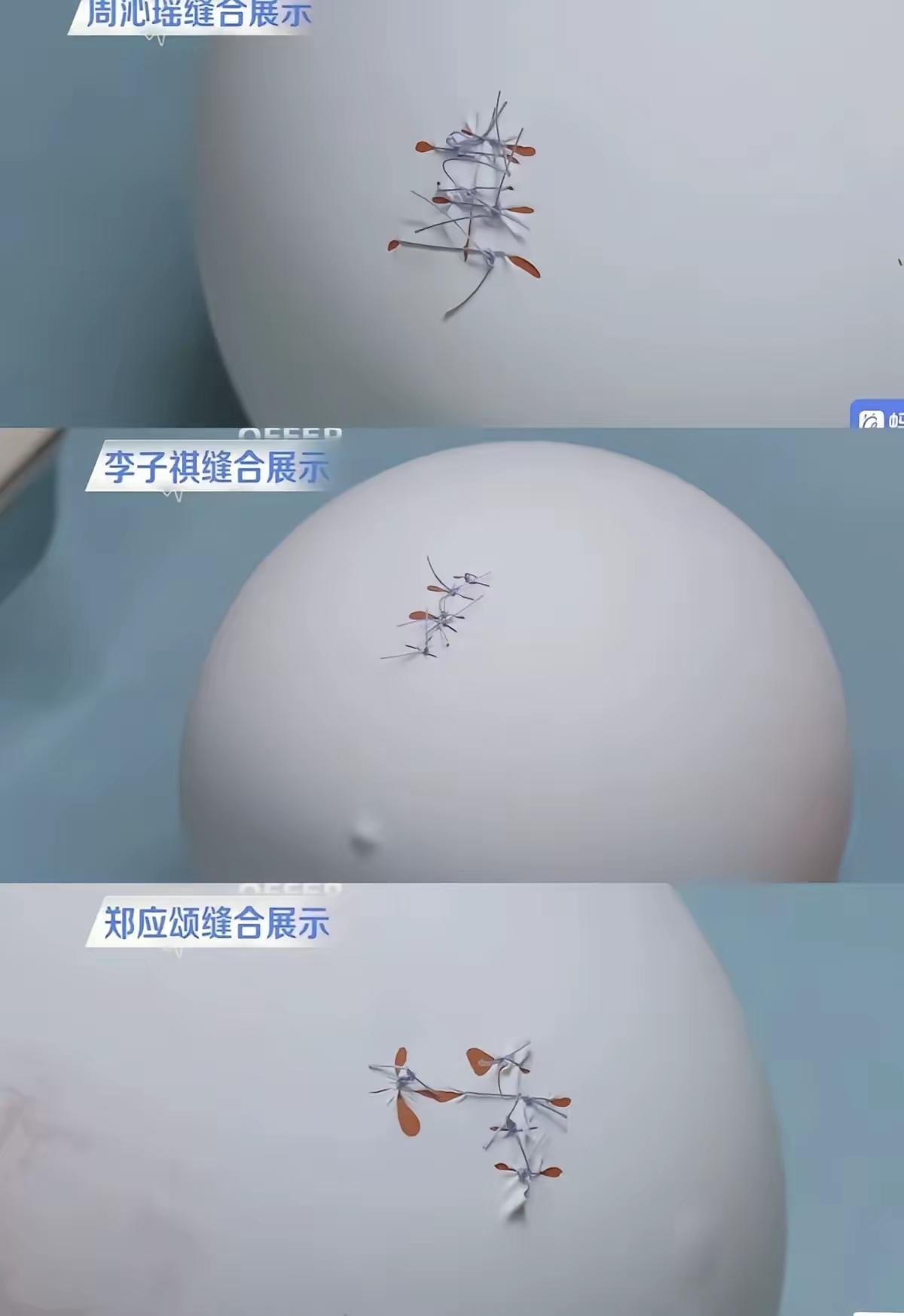 也许是我看多了短剧，我真的以为高水平的医生做手术后给患者缝合是在鸡蛋皮上锻炼出来