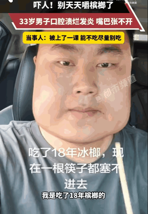 “湖北小伙33岁，嚼槟榔18年，脸型变方，腮帮子像槟榔一样肿圆。


”说起槟榔